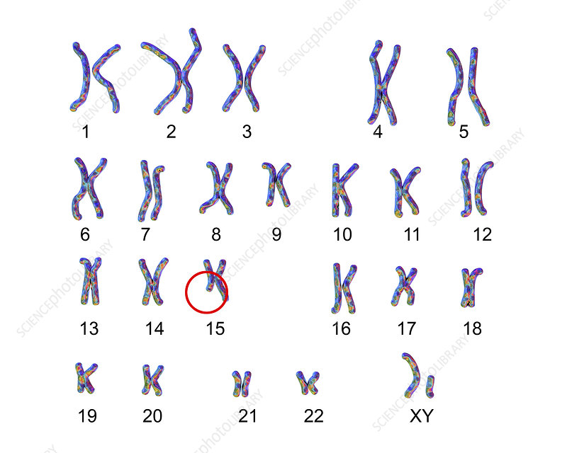 angelman syndrome